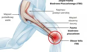 Anatomia pasma biodrowo-piszczelowego z zaznaczonym obszarem bólu.