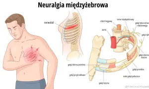 Ilustracja przedstawia mężczyznę z bólem w klatce piersiowej i schemat nerwu międzyżebrowego.