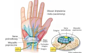 Ilustracja anatomiczna dłoni i nadgarstka z zaznaczonym nerwem pośrodkowym i więzadłem poprzecznym.