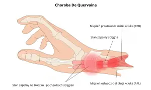 Ilustracja anatomiczna dłoni z zaznaczonym zapaleniem ścięgien kciuka (choroba De Quervaina).