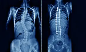 Rentgen kręgosłupa przed i po operacji korekcji skoliozy. Widoczny duży kąt cobba przed zabiegiem i wyprostowany kręgosłup z implantami po.