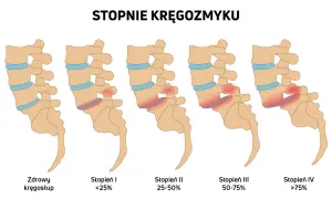 Ilustracja przedstawia pięć etapów kręgozmyku, od zdrowego kręgosłupa do zaawansowanego stopnia IV.