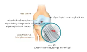 Anatomia kolana z zaznaczonym zerwanym więzadłem krzyżowym przednim (ACL).