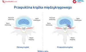 Ilustracja porównująca zdrowy krążek międzykręgowy z przepukliną uciskającą nerw.