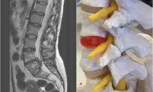 MRI kręgosłupa lędźwiowego i model anatomiczny ukazujący ucisk na nerw spowodowany dehydratacją krążków międzykręgowych.