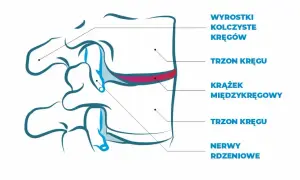 Schemat kręgosłupa z zaznaczonym krążkiem międzykręgowym, trzonami kręgów i nerwami rdzeniowymi.