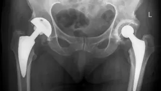 RTG miednicy po operacji biodra. Widoczne implanty stawów biodrowych po obu stronach.