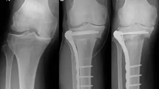 Rentgen kolana przed i po zabiegu osteotomii. Widoczna płyta i śruby stabilizujące kość.