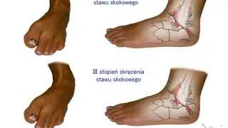 Ilustracje pokazują II i III stopień skręcenia stawu skokowego, z zaznaczonymi uszkodzeniami więzadeł. RTG stawu skokowego uwidacznia te urazy.