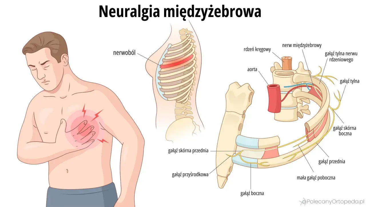 Ilustracja przedstawia mężczyznę z bólem w klatce piersiowej i schemat nerwu międzyżebrowego.