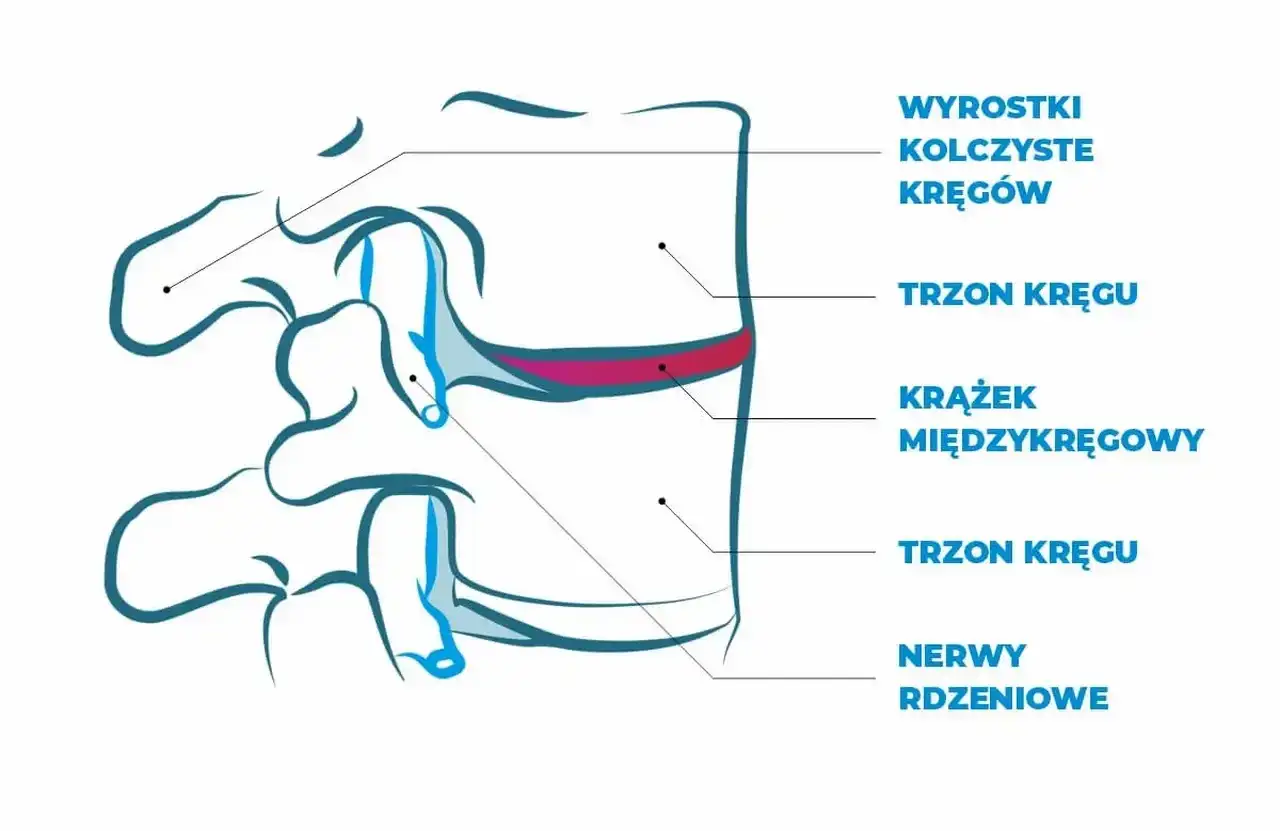 Schemat kręgosłupa z zaznaczonym krążkiem międzykręgowym, trzonami kręgów i nerwami rdzeniowymi.