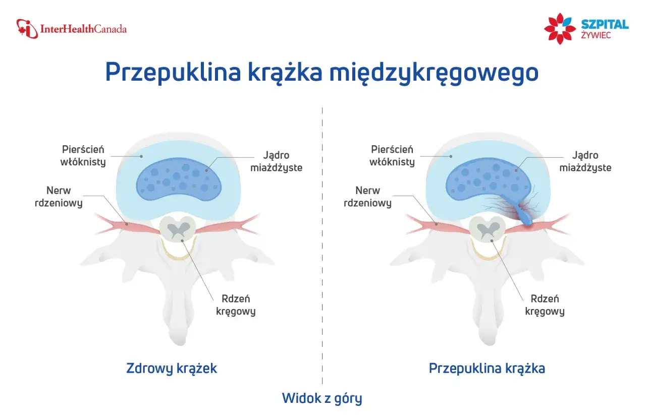 Porównanie zdrowego krążka międzykręgowego z przepukliną krążka, gdzie jądro miażdżyste uciska nerw rdzeniowy.