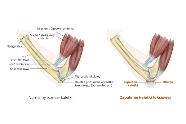 Ilustracja porównująca zdrową kaletkę łokciową z zapaloną, z widocznymi kośćmi i mięśniami.