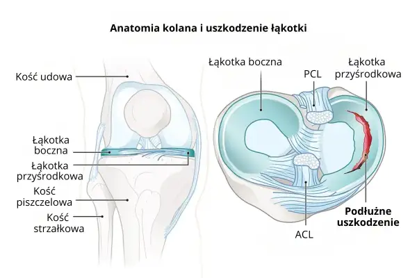 Ilustracja anatomii kolana z zaznaczonymi elementami, w tym uszkodzoną łąkotką przyśrodkową.