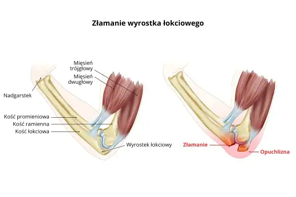 Ilustracja anatomiczna łokcia: zdrowy staw i złamanie wyrostka łokciowego z obrzękiem.