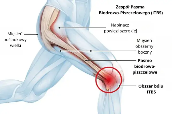 Anatomia pasma biodrowo-piszczelowego z zaznaczonym obszarem bólu.