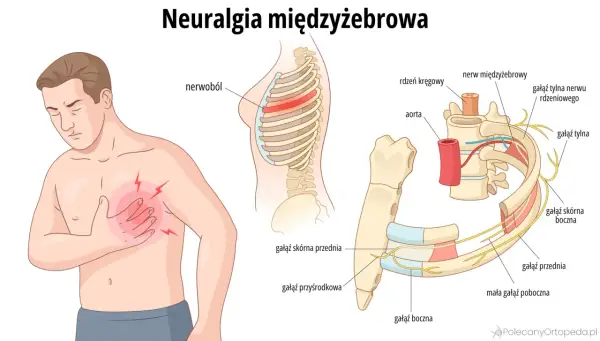 Ilustracja przedstawia mężczyznę z bólem w klatce piersiowej i schemat nerwu międzyżebrowego.