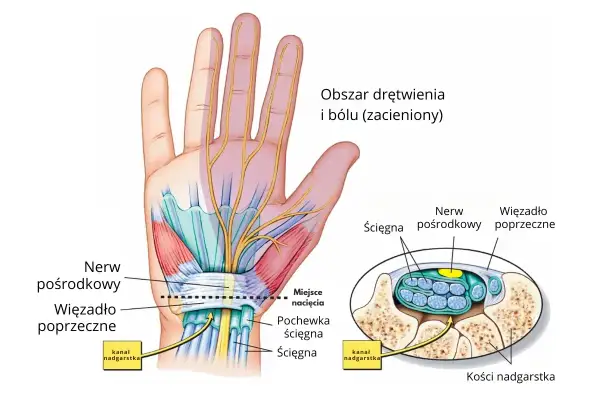 Ilustracja anatomiczna dłoni i nadgarstka z zaznaczonym nerwem pośrodkowym i więzadłem poprzecznym.