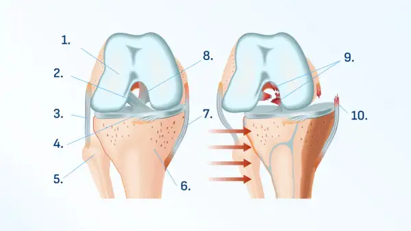 Ilustracja anatomiczna stawu kolanowego, pokazująca zdrową strukturę i uszkodzenie więzadła.