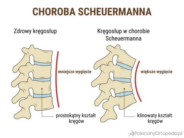 Ilustracja porównująca zdrowy kręgosłup z kręgosłupem w chorobie Scheuermanna.