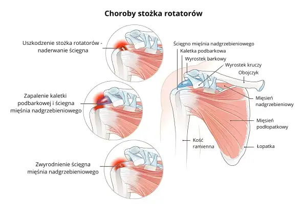 Ilustracja anatomiczna barku z zaznaczonymi uszkodzeniami stożka rotatorów: naderwanie ścięgna, zapalenie kaletki i zwyrodnienie.