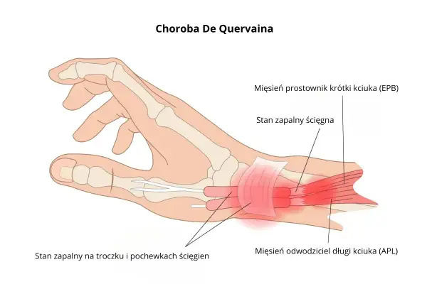 Ilustracja anatomiczna dłoni z zaznaczonym zapaleniem ścięgien kciuka (choroba De Quervaina).