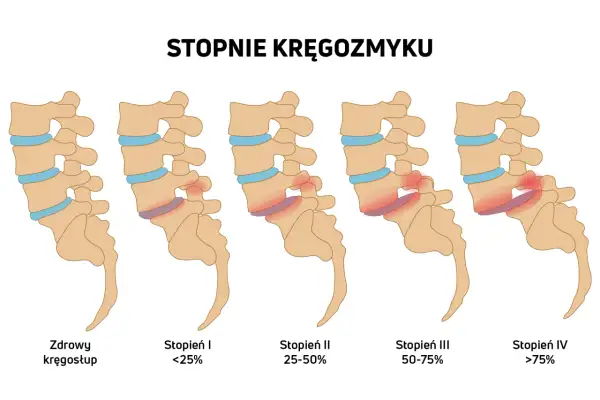 Ilustracja przedstawia pięć etapów kręgozmyku, od zdrowego kręgosłupa do zaawansowanego stopnia IV.