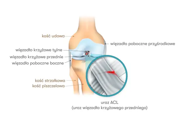 Anatomia kolana z zaznaczonym zerwanym więzadłem krzyżowym przednim (ACL).