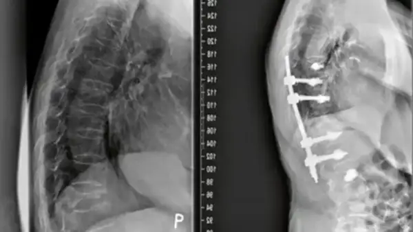 Rentgen kręgosłupa przed i po stabilizacji implantami.