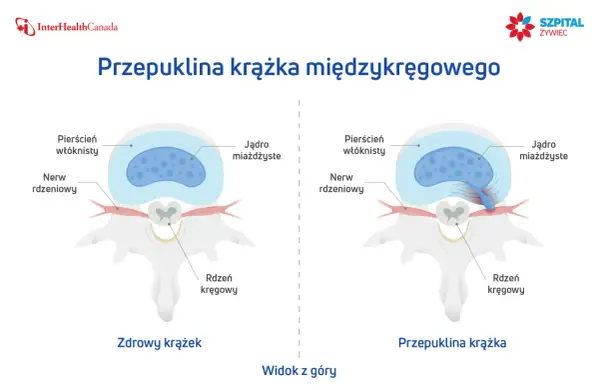 Ilustracja porównująca zdrowy krążek międzykręgowy z przepukliną uciskającą nerw.