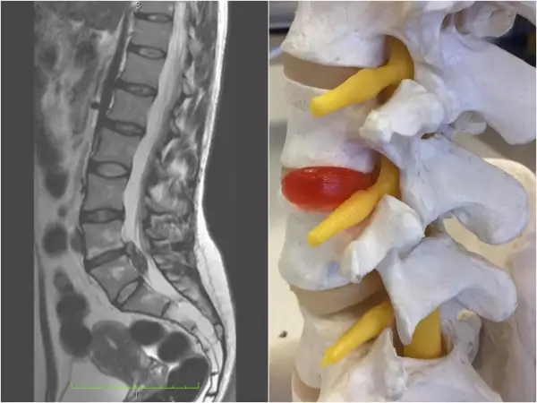 MRI kręgosłupa lędźwiowego i model anatomiczny ukazujący ucisk na nerw spowodowany dehydratacją krążków międzykręgowych.