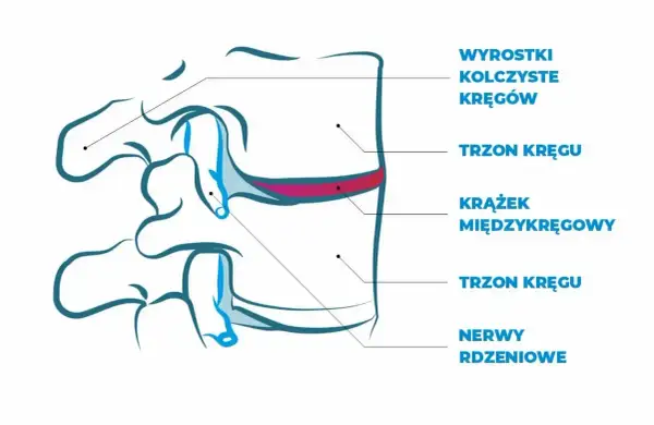Schemat kręgosłupa z zaznaczonym krążkiem międzykręgowym, trzonami kręgów i nerwami rdzeniowymi.