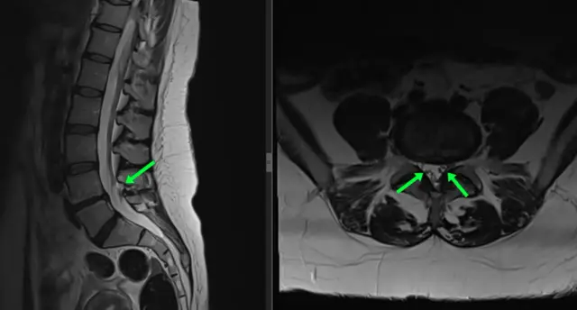 Obraz MRI kręgosłupa lędźwiowego pokazuje sekwestrację dysku z widocznym fragmentem krążka międzykręgowego uciskającym korzenie nerwowe.